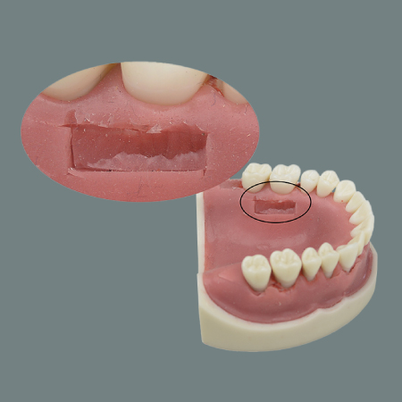 Gingiva Atrophy Lower jaw