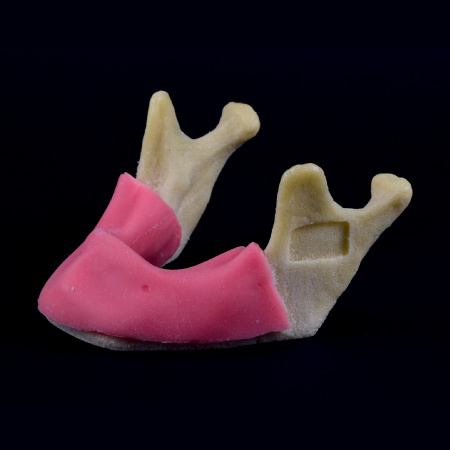 Anatomical Mandibular Atrophy With Soft Gum And Periosteum