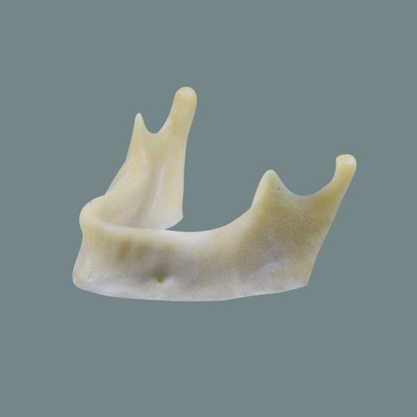 Mandibular Drilling Pediatric